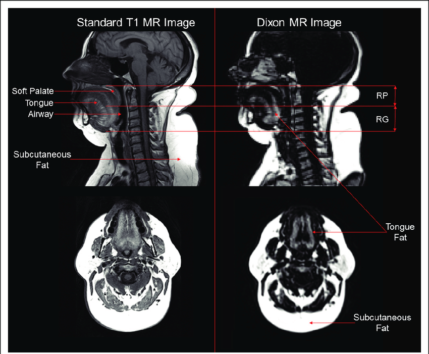 Sleep Apnea